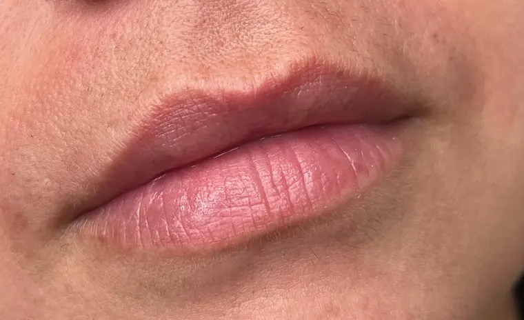 Transformação labial: antes do procedimento