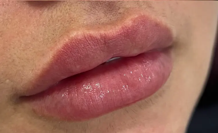 Transformação labial: depois do procedimento