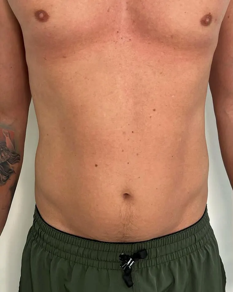 Lasershape: antes do procedimento