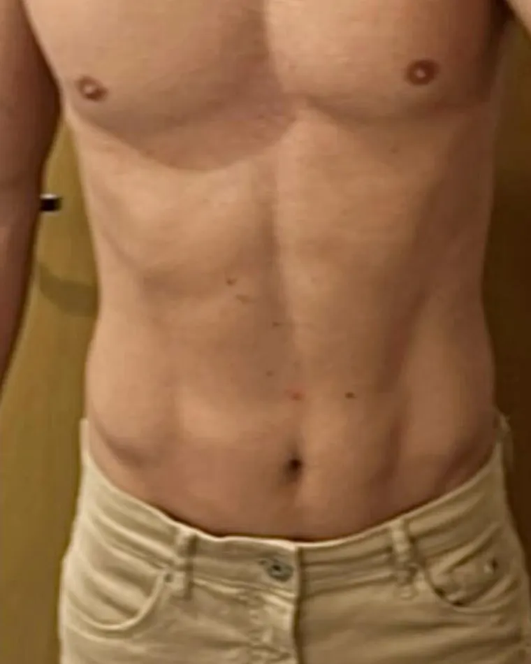 Lasershape: depois do procedimento