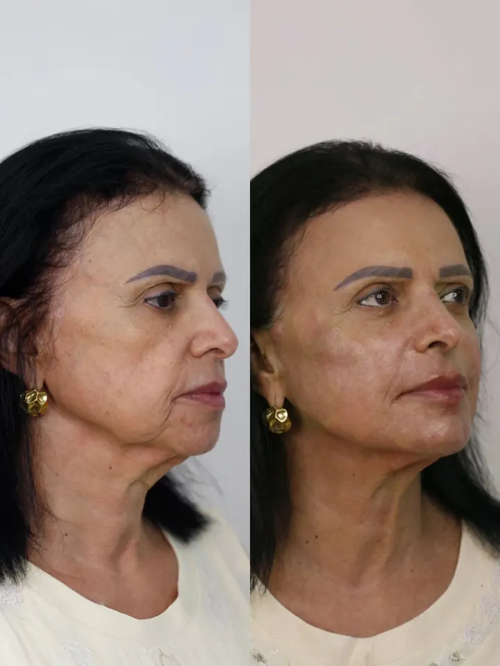 Contorno do rosto: antes à esquerda e depois à direita
