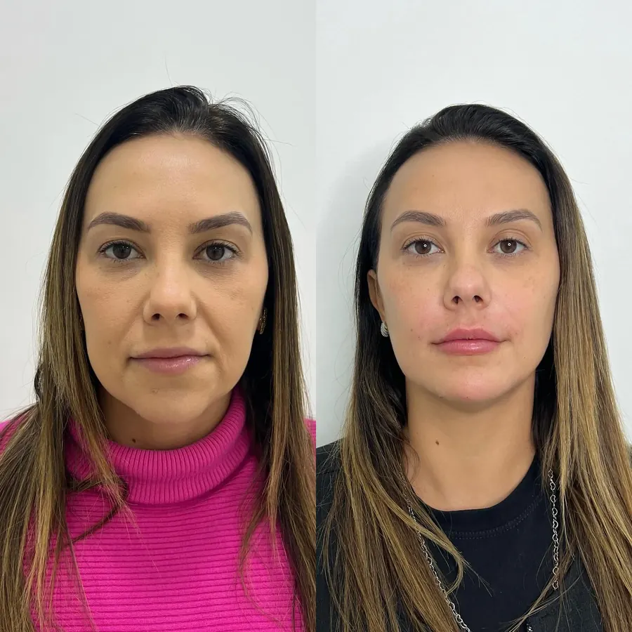 Rejuvenescer com leveza: antes à esquerda e depois à direita