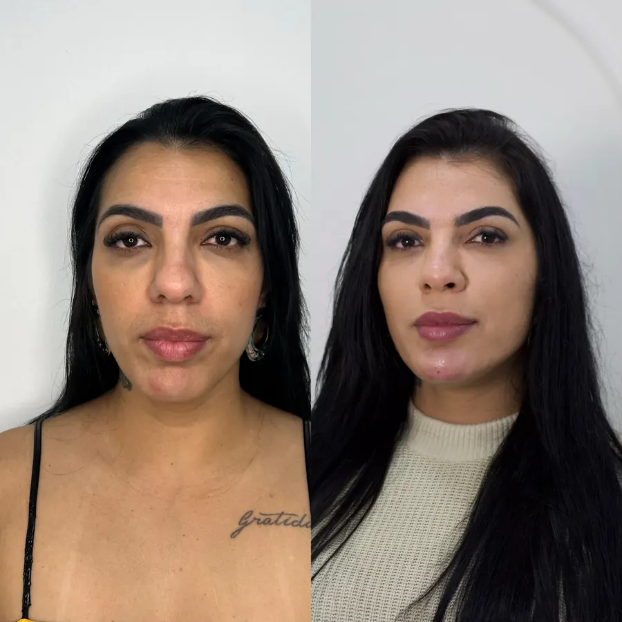 Valorização facial: antes à esquerda e depois à direita
