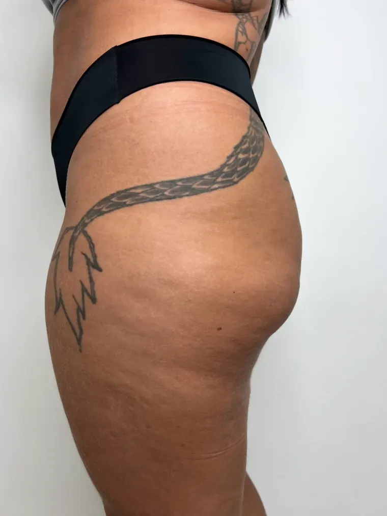 Um bumbum não se constrói em um dia: antes do procedimento