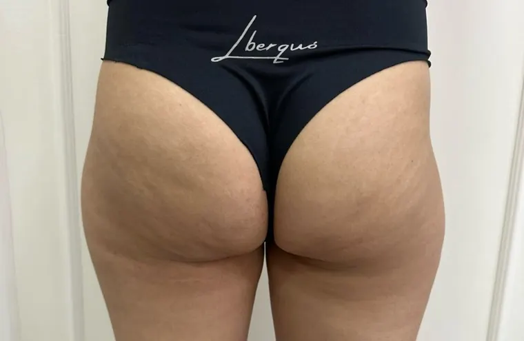 Hip dips preenchidos: antes do procedimento