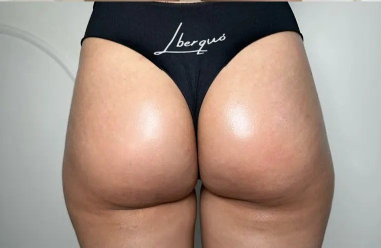 Hip dips preenchidos