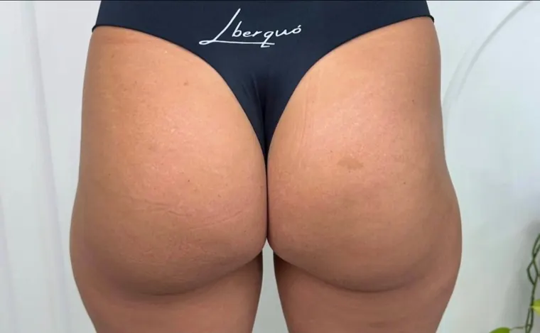 Hip dips na primeira sessão: antes do procedimento
