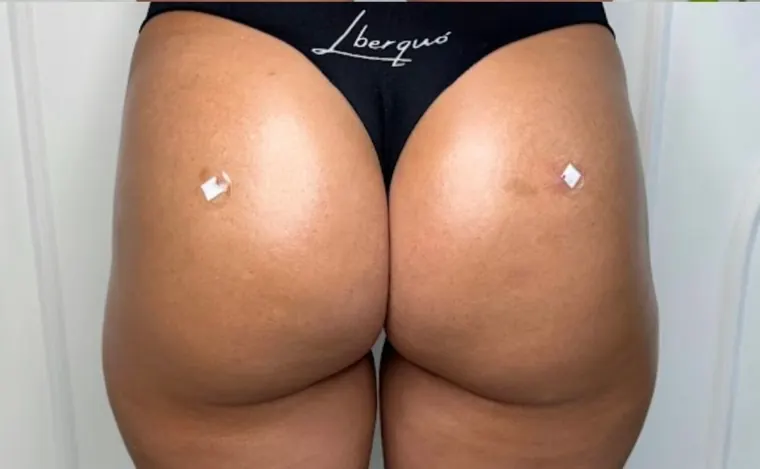 Hip dips na primeira sessão: depois do procedimento