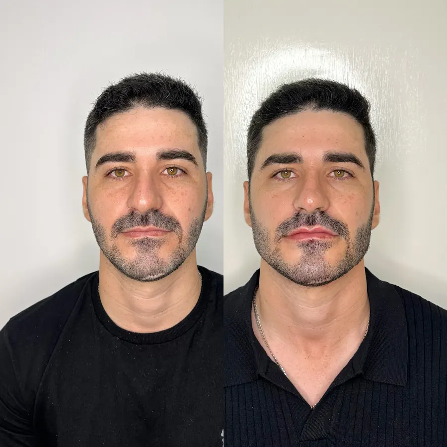 Harmonização masculina: antes à esquerda e depois à direita