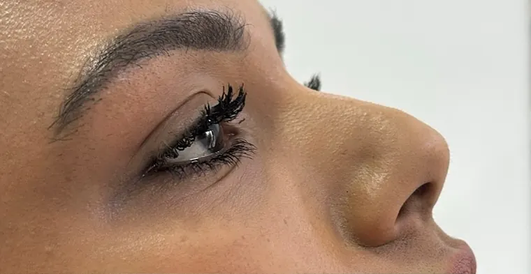 Nariz ainda mais bonito: antes do procedimento